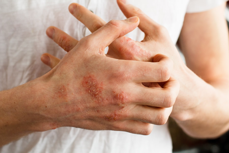 Psoriasis