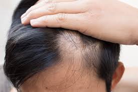 Alopecia (bald patches) management