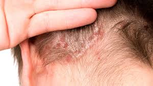 Scalp Psoriasis