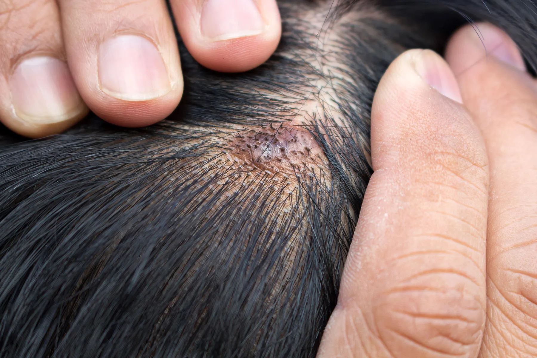 scalp infection care